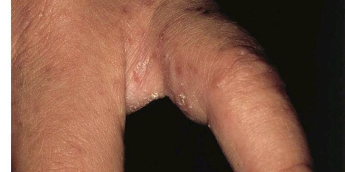 Skabies: Si Tungau Pembuat Gatal