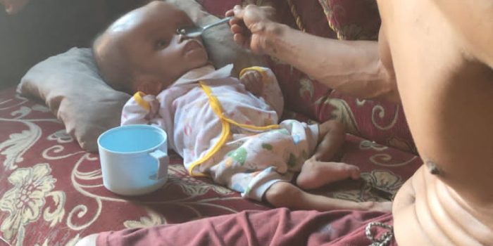 Derita Penyakit Hidrosefalus, Bocah 7 Tahun di Lamtim Butuh Perhatian Pemerintah