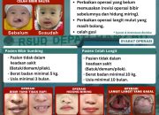 RSUD Depati Hamzah Kota pangkalpinang Buka Baksos Operasi Bibir dan Langit Mulut Sumbing dalam Rangka Dukung Program 100 Hari Kerja